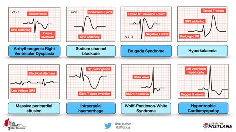 Killer ECG Patterns: Part 1 • LITFL • ECG Library.